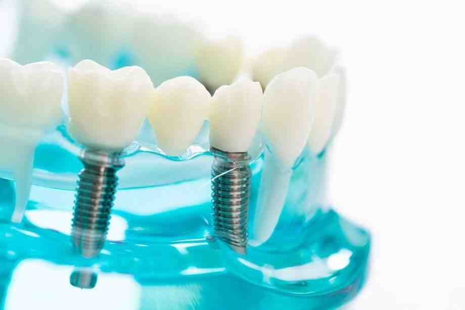 How many dental implants can you have at once?