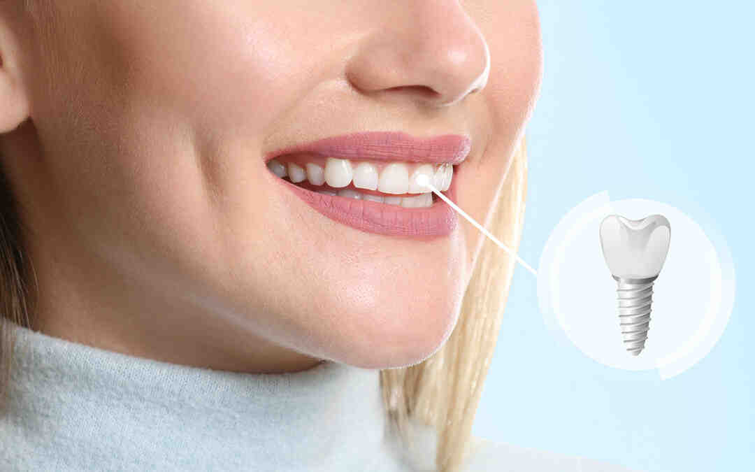How many dental implants can you have at once?