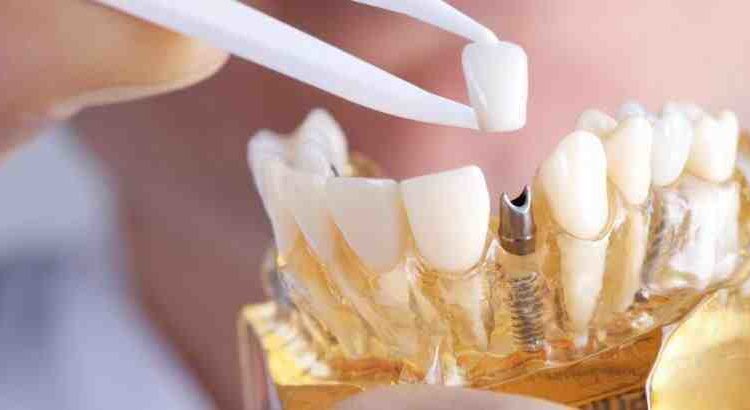 How many dental procedures are there involved in getting implants