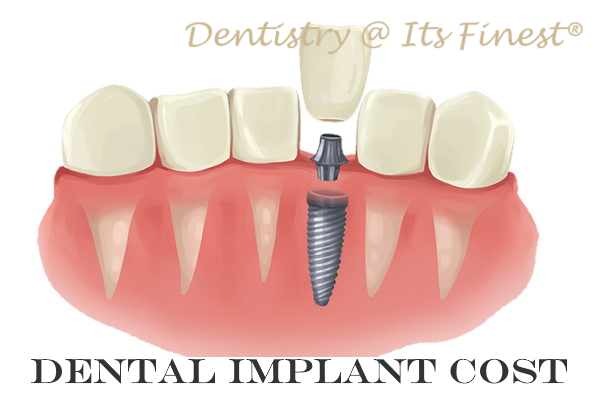 How many teeth are in All-on-4?