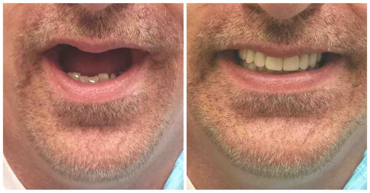How many teeth are in a full dental implant?