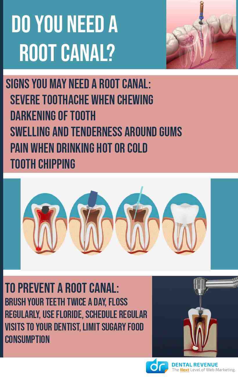 How many times can a root canal be retreated?