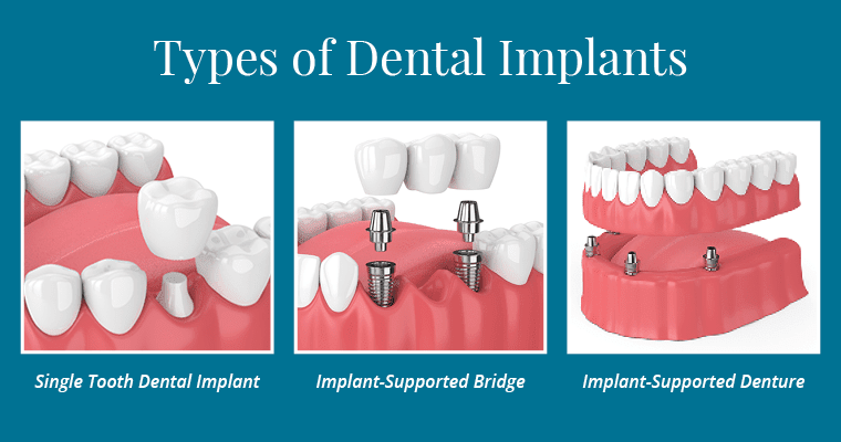 How much does a full set of teeth implants cost in Turkey?