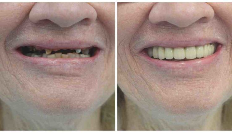 How much is a crown for a tooth?