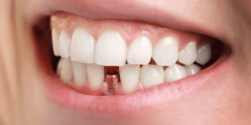 How much is a tooth implant?