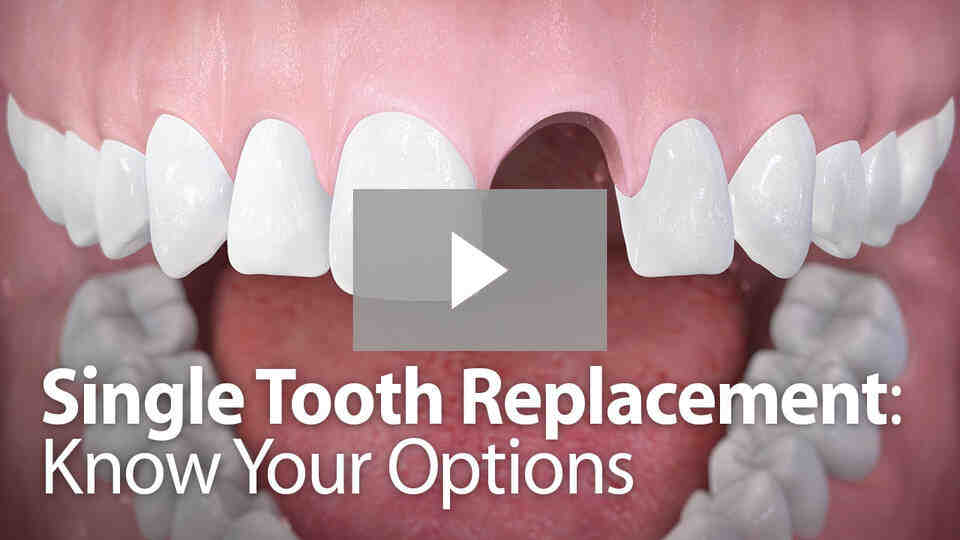 How much is all on 4 dental implants in Mexico?