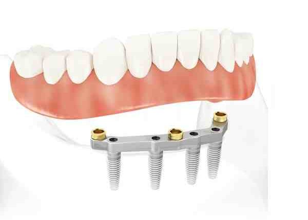 How much is all on four dental implants