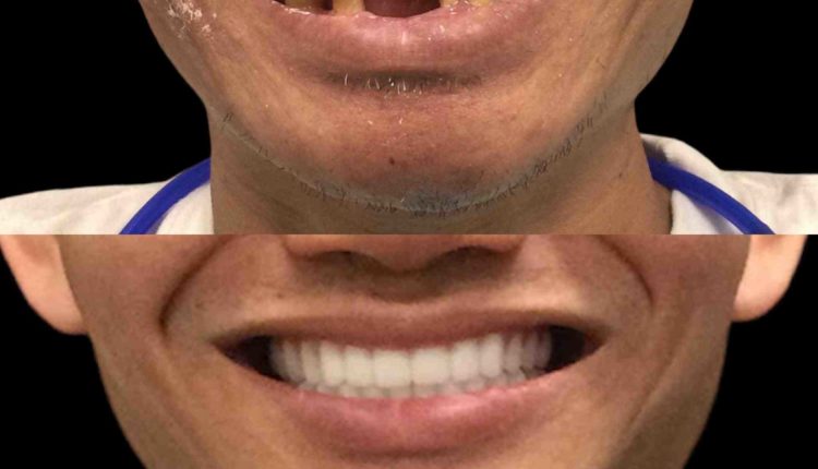 How much is it to get dental implants