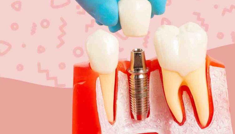 How much is supplemental dental insurance for tooth implants