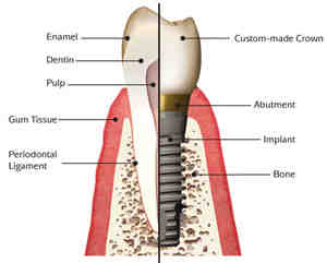 How often should implants be checked?