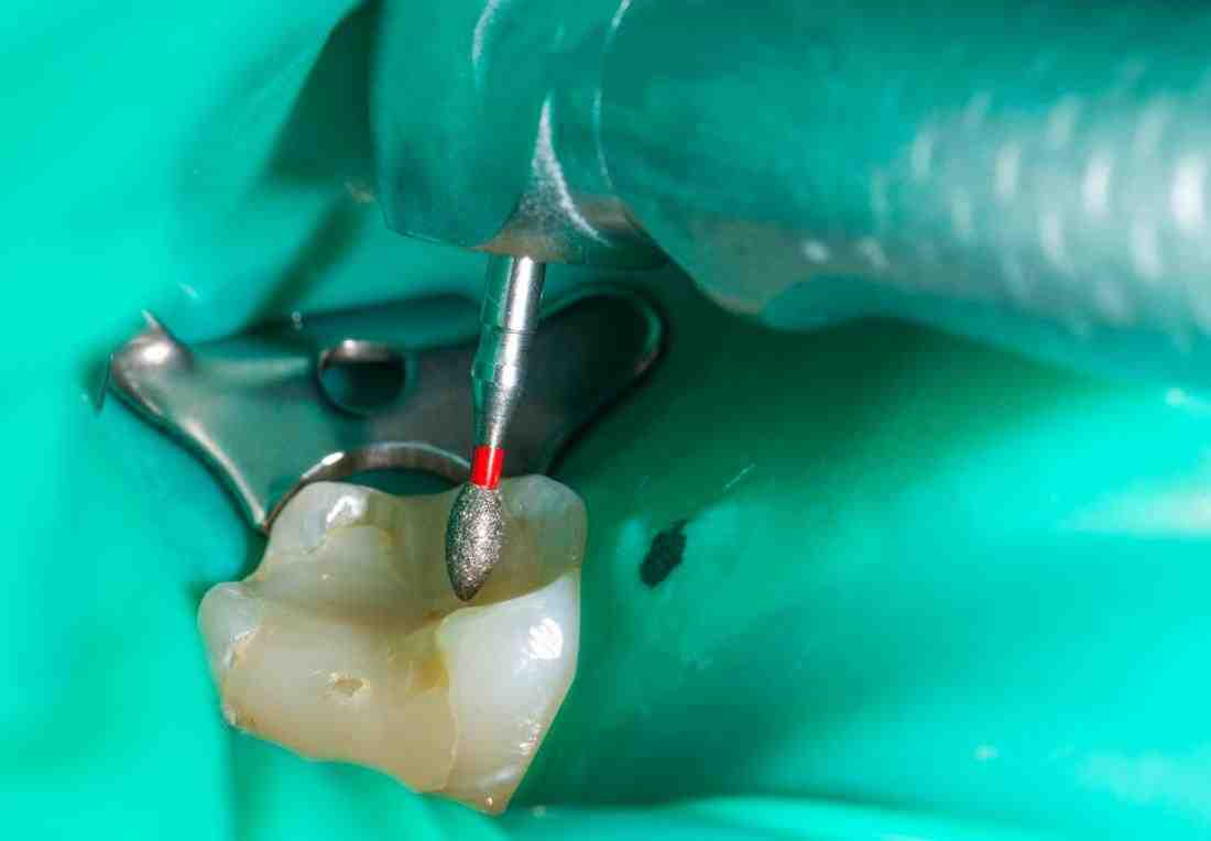 How painful is a root canal?
