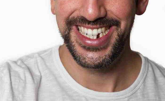 How to get a beautiful smile without dental implants