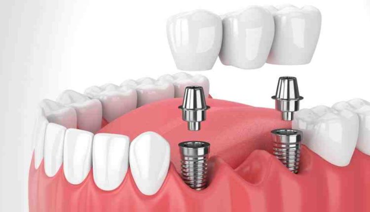 How to get insurance to pay for dental implants