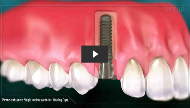 How to keep food out of a healing cap for dental implant