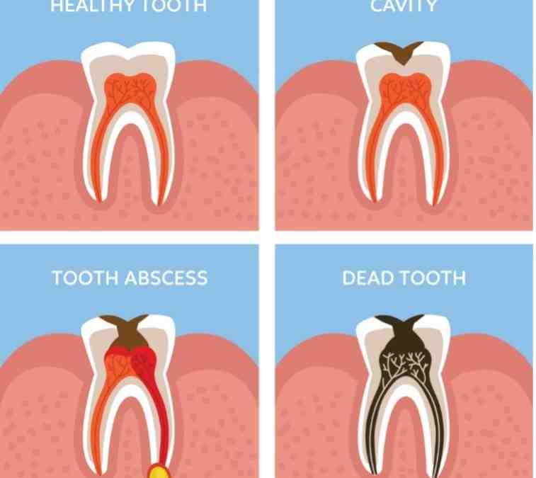 Is a root canal mandatory?