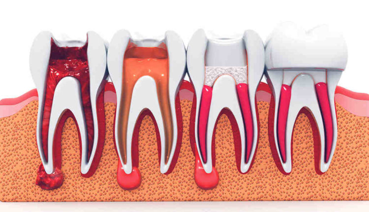 Is a root canal tooth still alive?