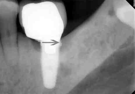 Is dentist responsible for failed crown?