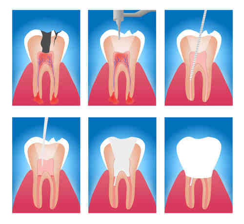 Is getting a root canal a big deal?