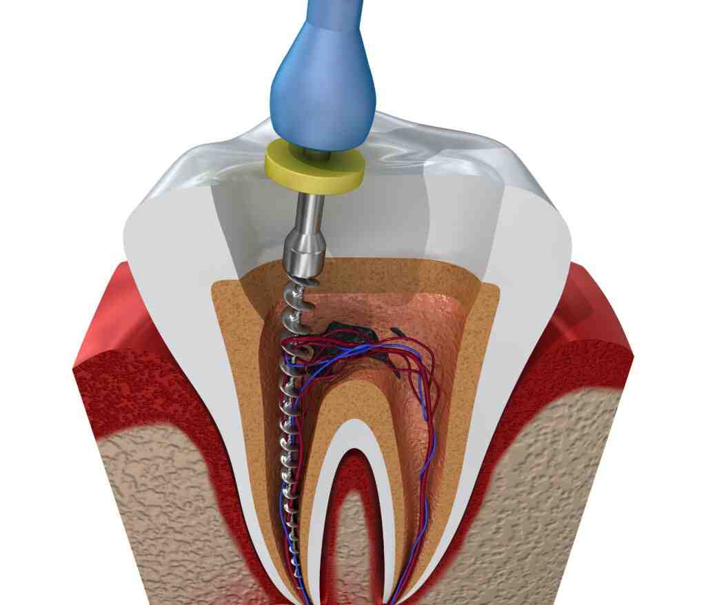 Is it better to do a root canal or extraction?