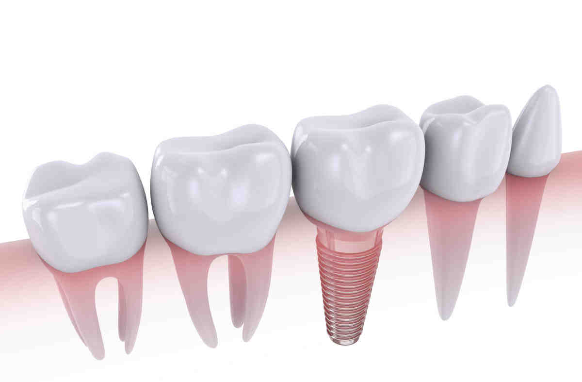 Is it better to get a bridge or implant?