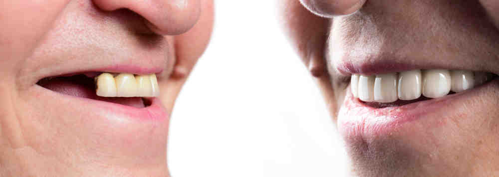 Is it better to get a bridge or implant?
