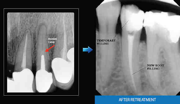 Is it better to get root canal or implant?