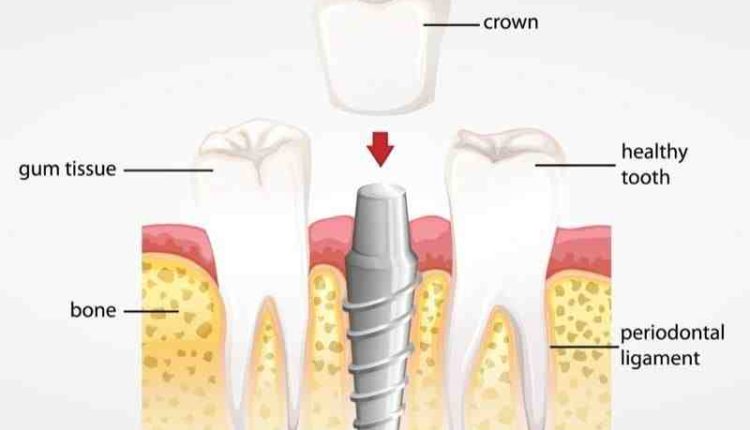 Is it better to have a root canal or implant?