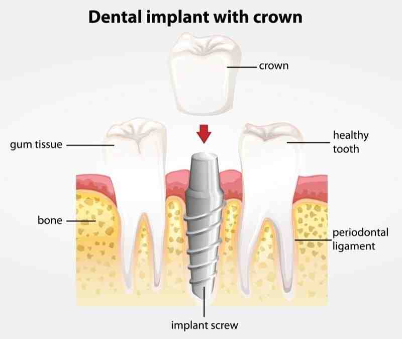 Is It Better To Have A Root Canal Or Implant Dental News Network