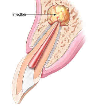 Is it normal to have 2 root canals?