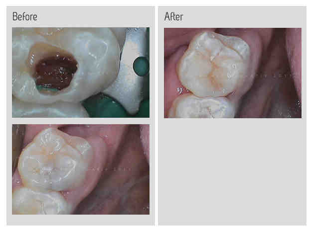 Is it normal to have nerve pain after a root canal?