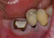 Is it painful to extract a root canal tooth?