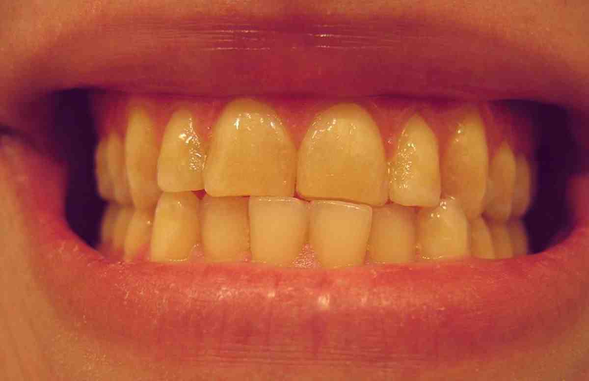 Is it possible to fix yellow teeth?
