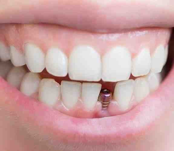 Is it worth getting a molar implant?