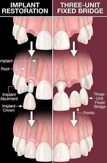 Is it worth going to Mexico for dental implants?