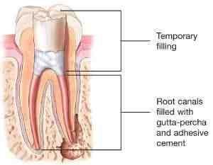 Is it worth having a root canal?