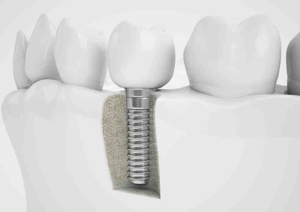 Is second stage of dental implant painful?