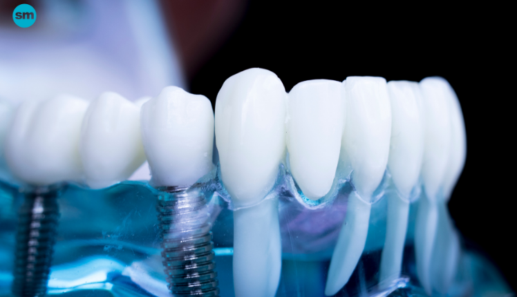Is there financing for dental implants