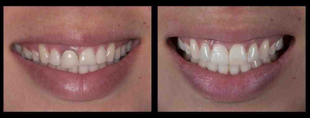 Quels sont les risques des implants ?