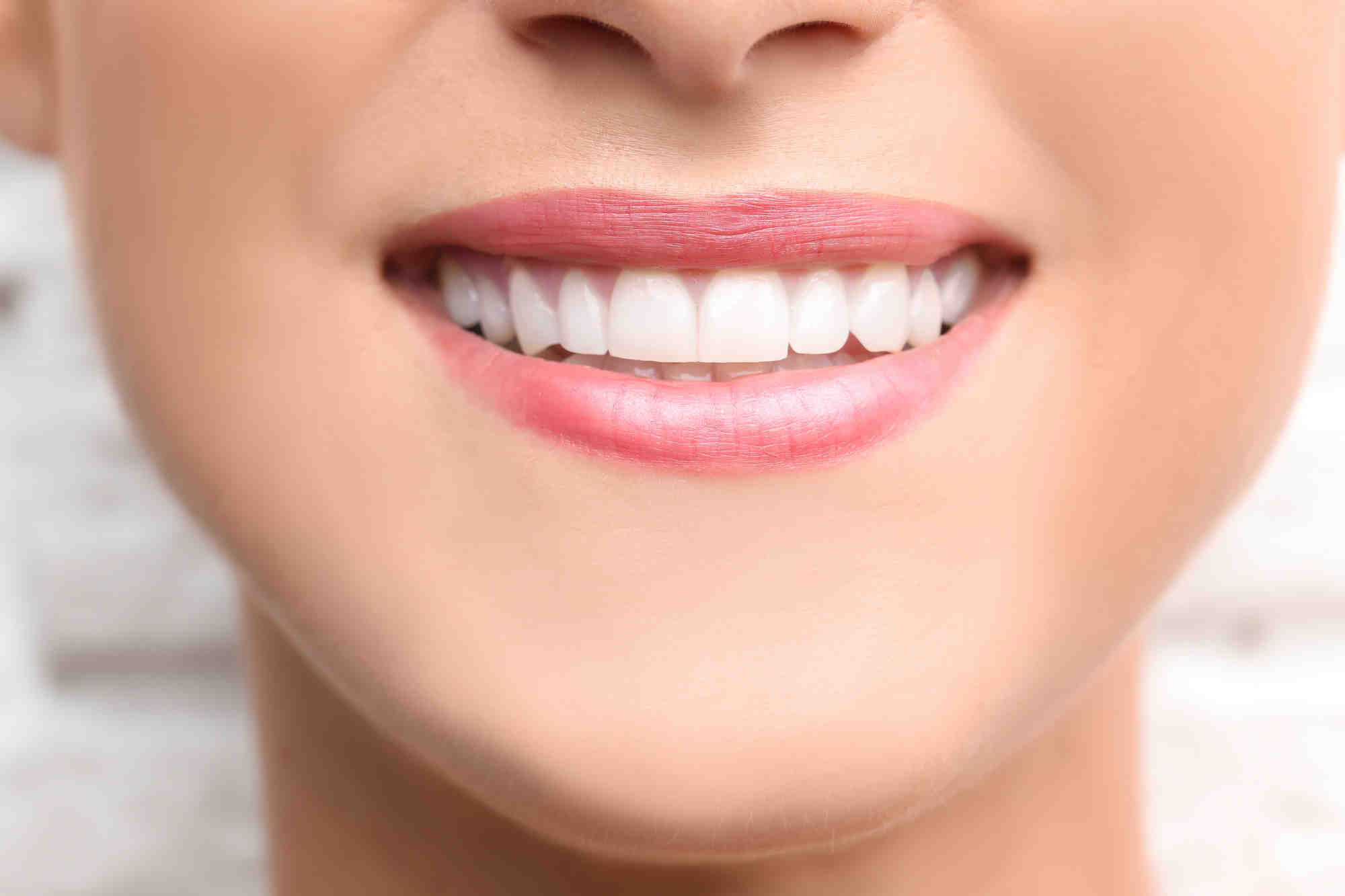 Should I get bonding before or after Invisalign?