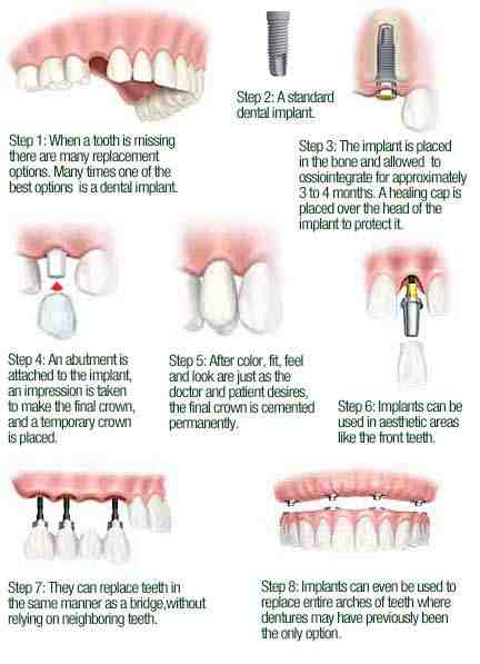 What are dental implant made of?