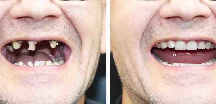 What are dentures like today?