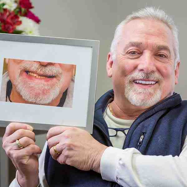 What Are Full Mouth Dental Implants Dental News Network