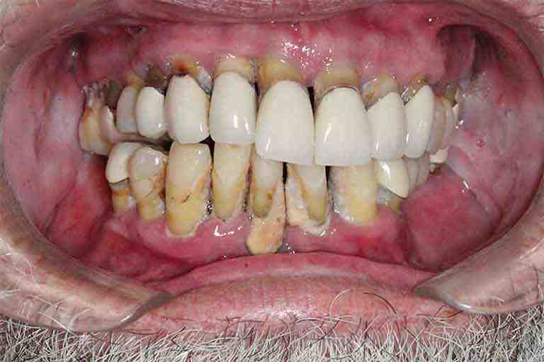 What are the 3 stages of dental implants?