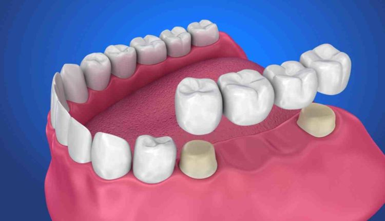 What are the disadvantages of dental crowns?