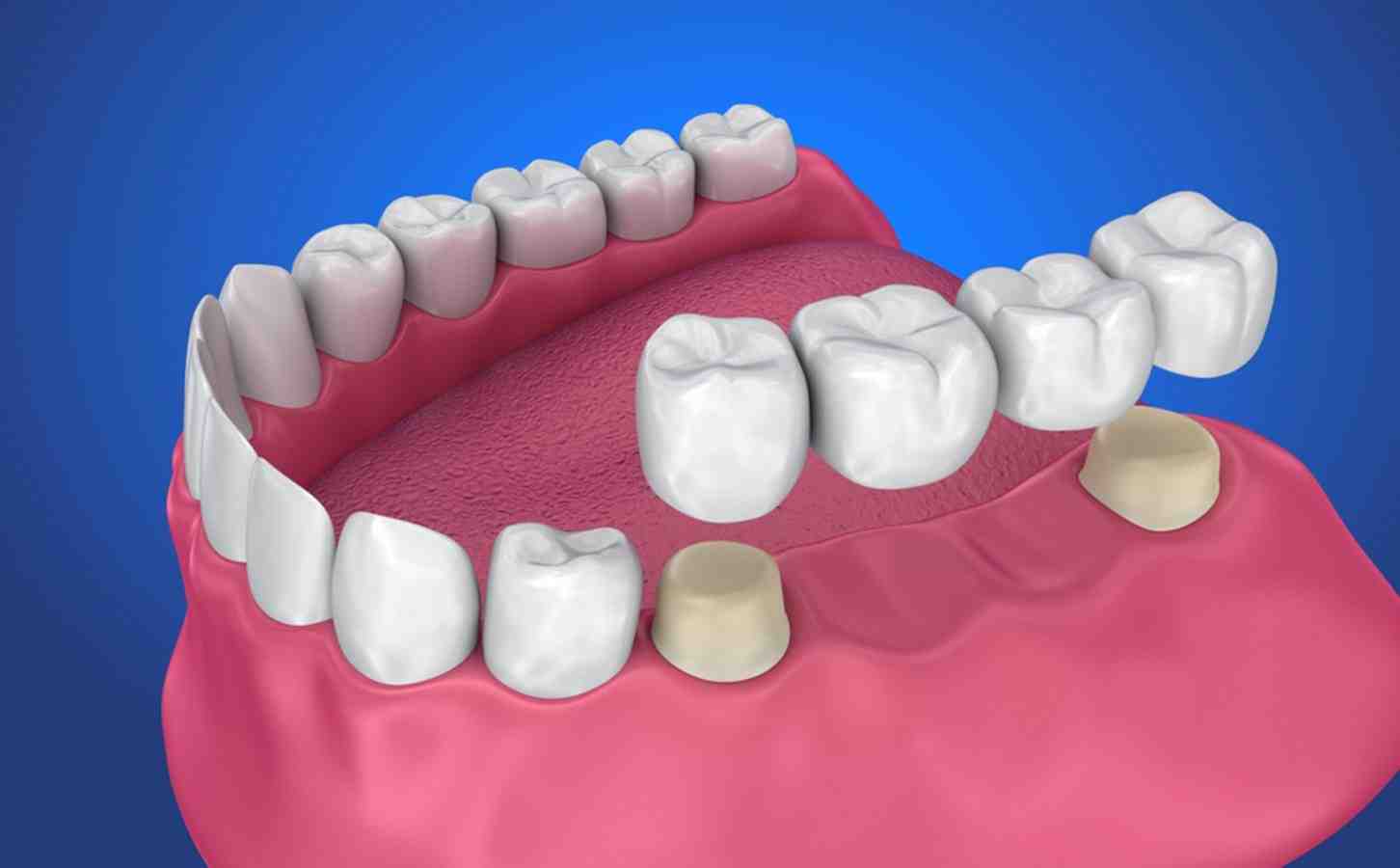 What are the disadvantages of dental crowns?