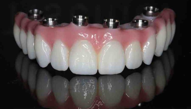 What are the phases of getting dental implants