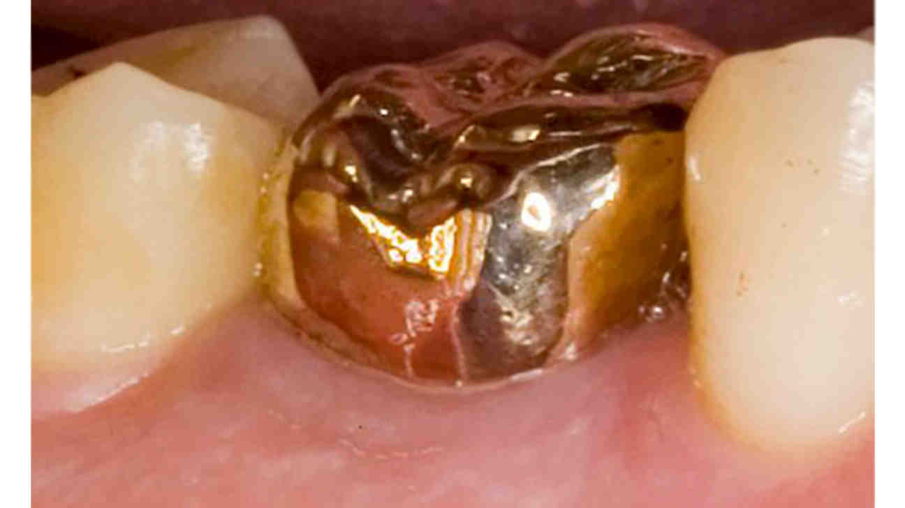 What are the pros and cons of dental crowns?