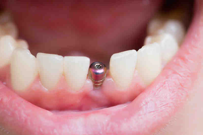 What are the side effects of titanium implants?