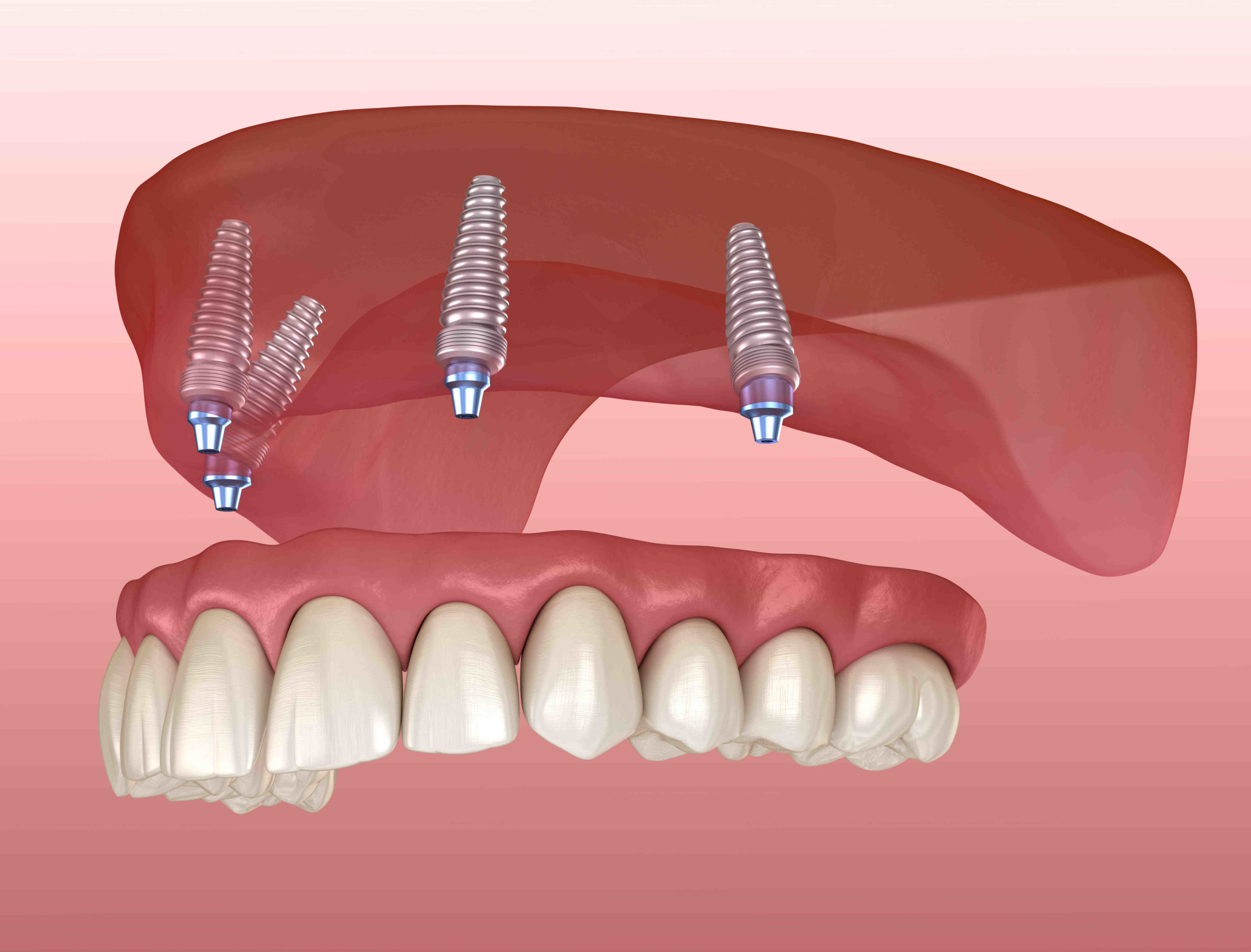 What are the steps of getting full mouth dental implants?