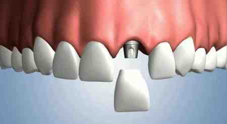 What are the three major reasons for failure of implants?